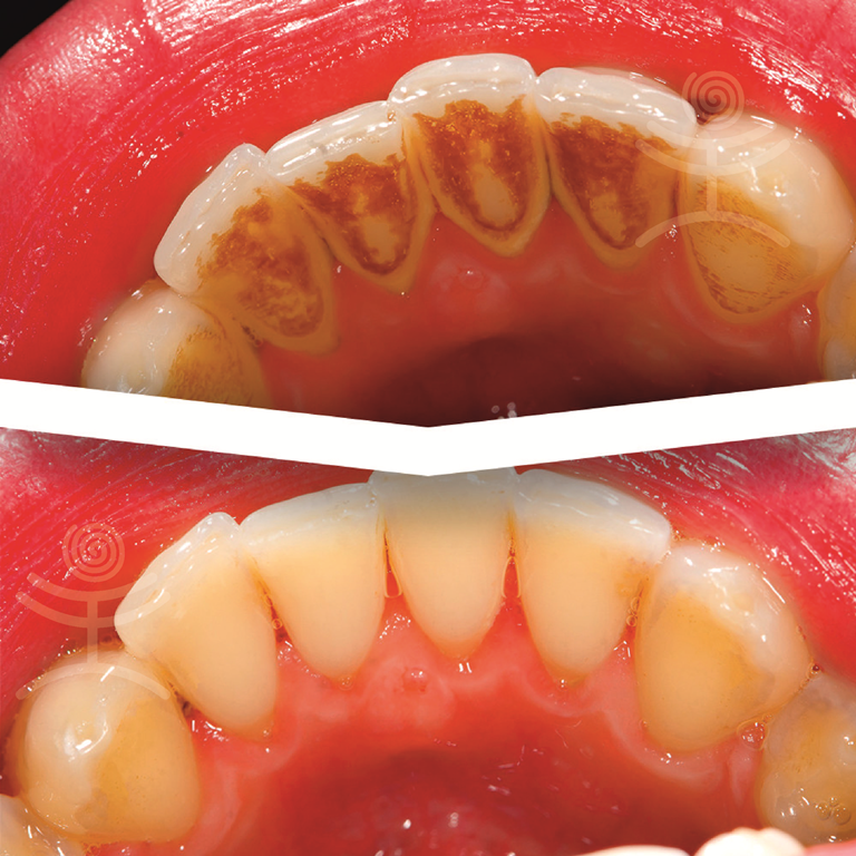 Dentální hygiena před a po | Klinika Mediestetik