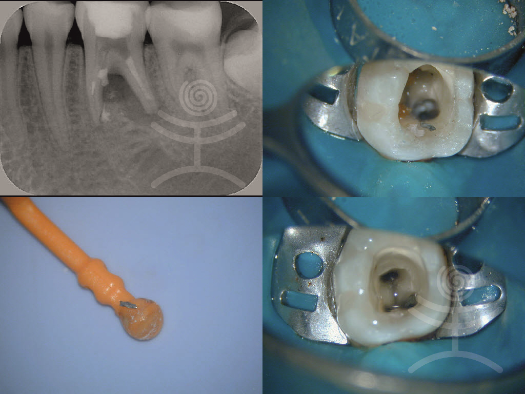 Zubní kanálek, odstranění cizího tělesa | Klinika Mediestetik