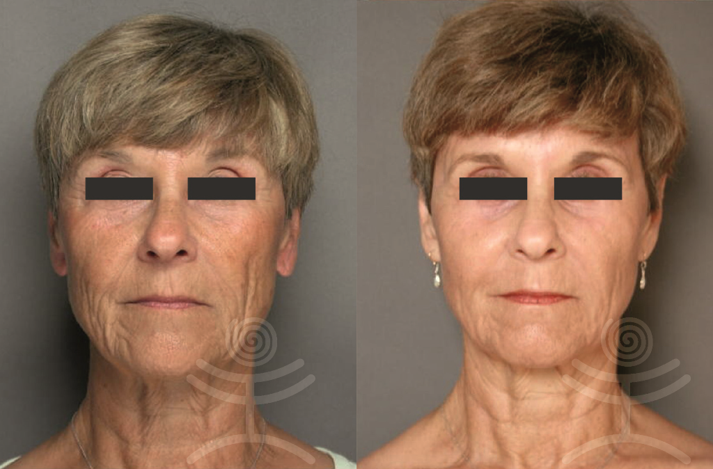 Omlazení obličeje laserem | Klinika Mediestetik