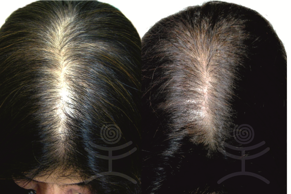 Vlasová mezoterapie | Klinika Mediestetik