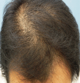 DANN Therapie bei dem Haarverlust RegenPlasma | Klinika Mediestetik