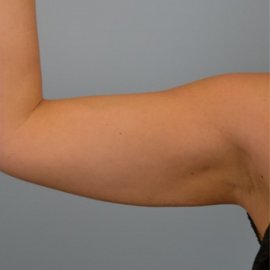 Plastic arm surgery: Arm Lift | Klinika Mediestetik