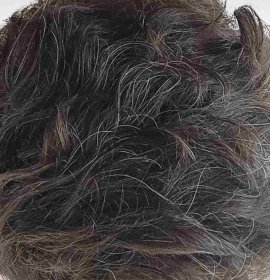 Langhaartransplantation für Frauen ohne Rasur (Long Hair FUE) | Klinika Mediestetik