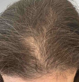 Langhaartransplantation für Frauen ohne Rasur (Long Hair FUE) | Klinika Mediestetik