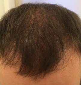 Hair transplantation | Klinika Mediestetik