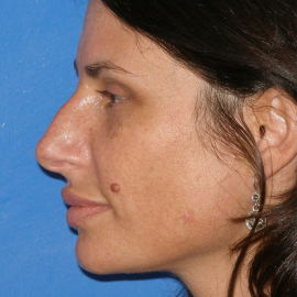Eine nicht invasive Rhinoplastik ohne Operation für die Nasenbearbeitung | Klinika Mediestetik