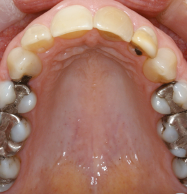 CEREC: The One-Visit Dentistry | Klinika Mediestetik