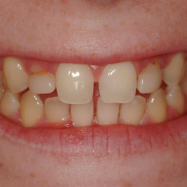 Smile-lifting: Aesthetic Teeth Restoration | Klinika Mediestetik