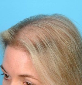 Hair Mesotherapy | Klinika Mediestetik