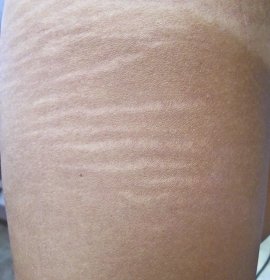 Removal of scars and stretch marks laser | Klinika Mediestetik