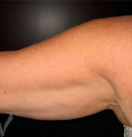 Mesothreads body lifting | Klinika Mediestetik
