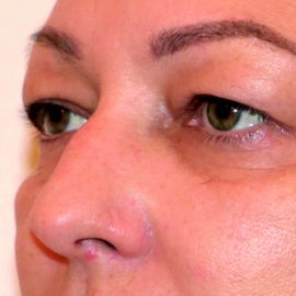 Operace očních víček: Blefaroplastika | Klinika Mediestetik