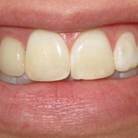 Professional Teeth Whitening | Klinika Mediestetik