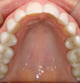 CEREC: The One-Visit Dentistry | Klinika Mediestetik