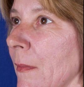 Resurfacing obličeje laserem, omlazení Venus Viva | Klinika Mediestetik