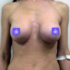 Breast plastic surgery: Enlargement | Klinika Mediestetik