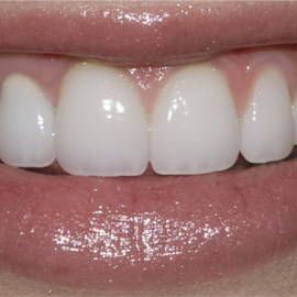 Professional Teeth Whitening | Klinika Mediestetik