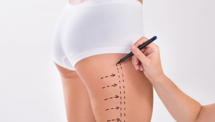 Odsáváme ceny za liposukci | Klinika Mediestetik