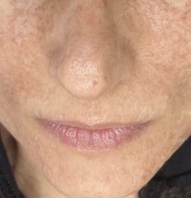 MCT – Cellular rejuvenation powered by exosomes | Klinika Mediestetik