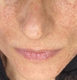 MCT – buněčné omlazení pomocí vlastních exozomů | Klinika Mediestetik