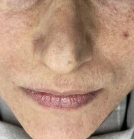 MCT – Cellular rejuvenation powered by exosomes | Klinika Mediestetik