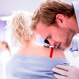 Laser Removal of Birthmarks, Wart, Moles | Klinika Mediestetik
