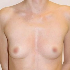 Augmentace prsou minimálně invazivní metodou Preservé | Klinika Mediestetik