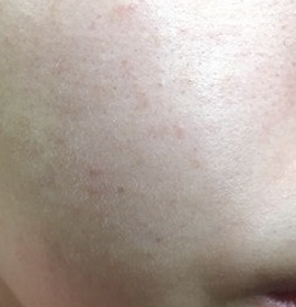 NEW: Exosome Therapy – A Breakthrough in Skin Rejuvenation | Klinika Mediestetik