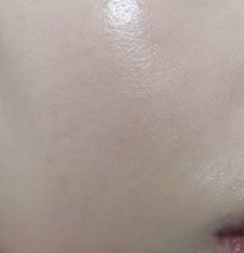 NEW: Exosome Therapy – A Breakthrough in Skin Rejuvenation | Klinika Mediestetik