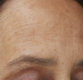 Rejuvenace pleti pomocí frakčního laseru MOXI® | Klinika Mediestetik