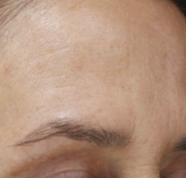 Rejuvenace pleti pomocí frakčního laseru MOXI® | Klinika Mediestetik