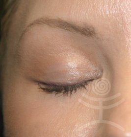 Non-invasive lifting Thermage of Eyelid | Klinika Mediestetik