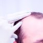 Vlasová mezoterapie | Klinika Mediestetik